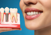The Life-Changing Benefits of Dental Implants: Function, Aesthetics, and Health