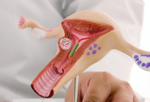 IUI Treatment: A Modern Solution for Fertility Challenges