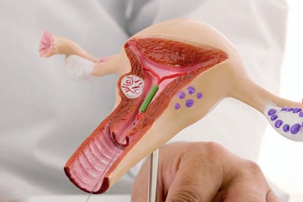 IUI Treatment: A Modern Solution for Fertility Challenges