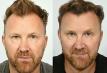 Turkey or the United States for a Hair Transplant? You Are Comparing the Wrong Two Things