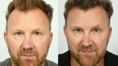 Turkey or the United States for a Hair Transplant? You Are Comparing the Wrong Two Things