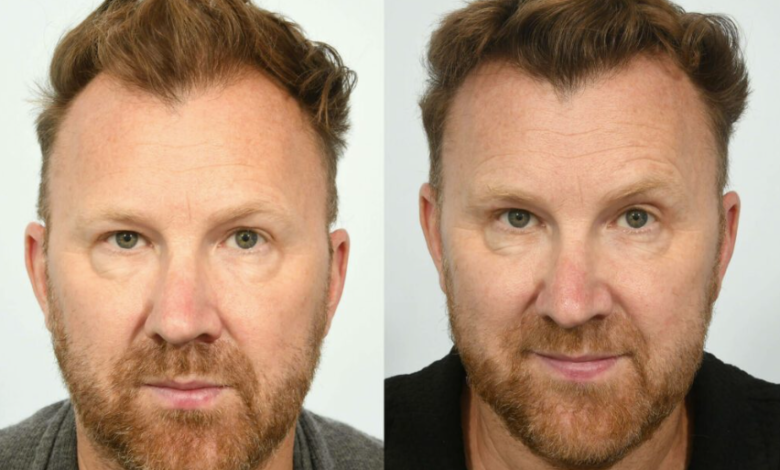 Turkey or the United States for a Hair Transplant? You Are Comparing the Wrong Two Things